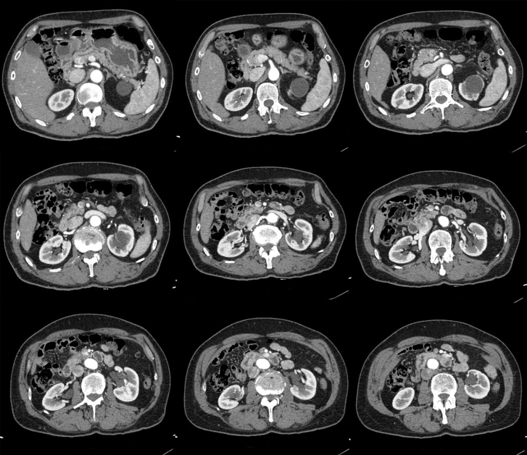 【病例】容易误诊为肾囊肿的肾盏憩室1例CT影像-3