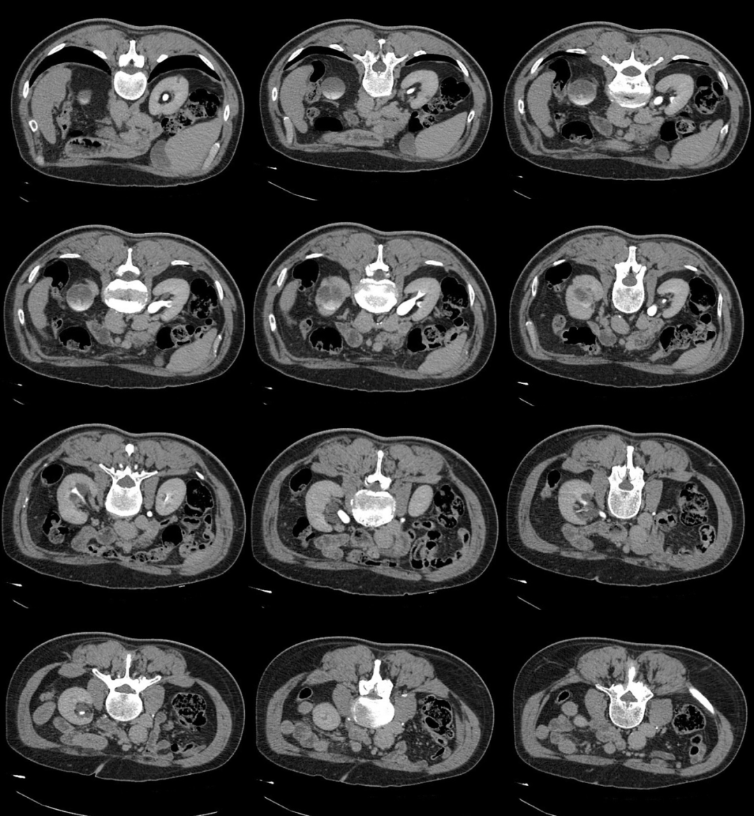 【病例】容易误诊为肾囊肿的肾盏憩室1例CT影像-7