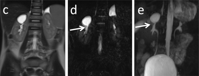 【病例】容易误诊为肾囊肿的肾盏憩室1例CT影像-14