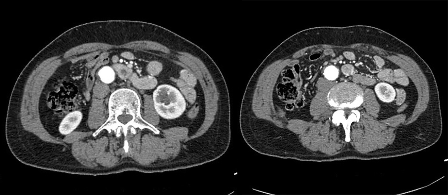 【病例】容易误诊为肾囊肿的肾盏憩室1例CT影像-4
