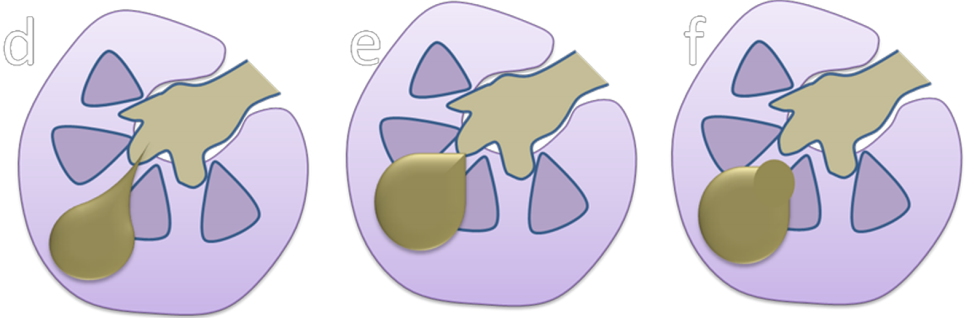 【病例】容易误诊为肾囊肿的肾盏憩室1例CT影像-11