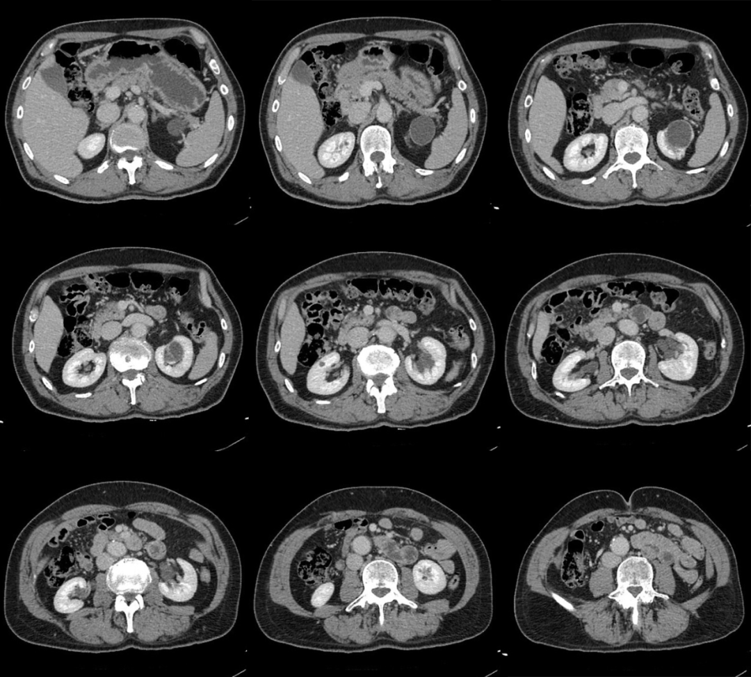 【病例】容易误诊为肾囊肿的肾盏憩室1例CT影像-5