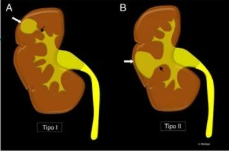 【病例】容易误诊为肾囊肿的肾盏憩室1例CT影像-9
