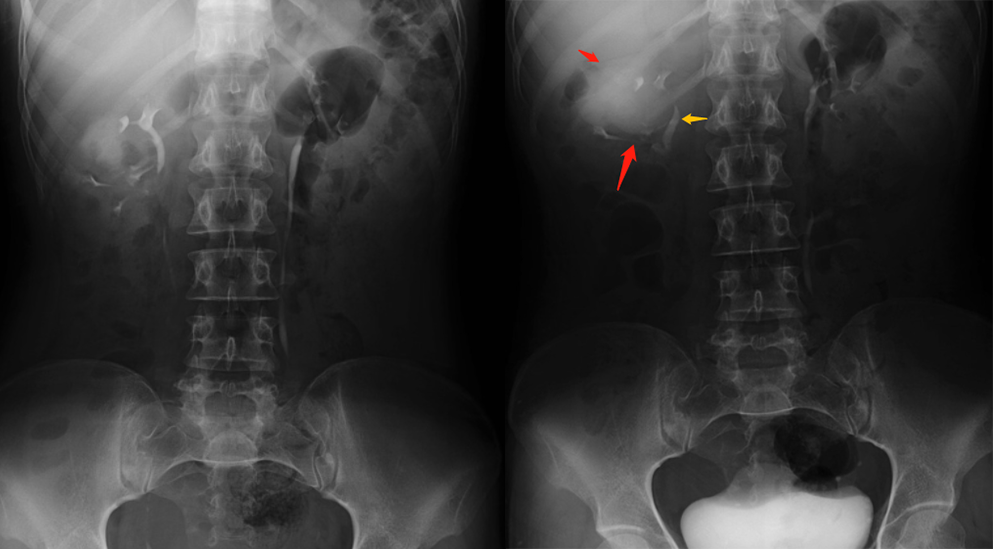 【病例】容易误诊为肾囊肿的肾盏憩室1例CT影像-12