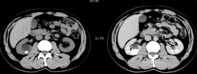 【病例】容易误诊为肾囊肿的肾盏憩室1例CT影像-13
