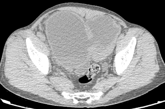 【病例】腺性膀胱炎2例CT影像表现-5