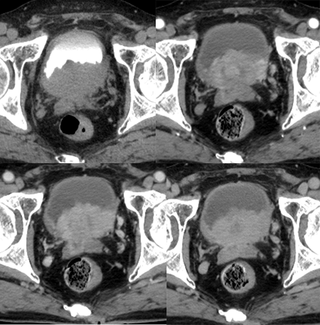 【病例】腺性膀胱炎2例CT影像表现-4