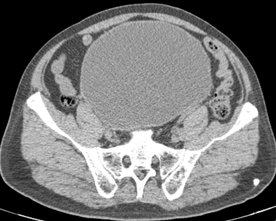 【病例】腺性膀胱炎2例CT影像表现-6