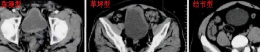 【病例】腺性膀胱炎2例CT影像表现-3