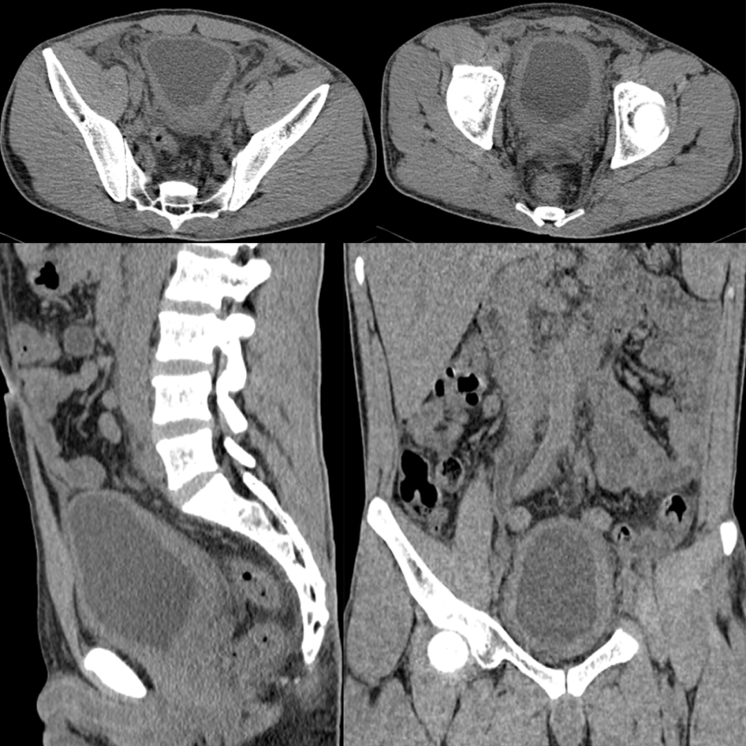 【病例】腺性膀胱炎2例CT影像表现-1