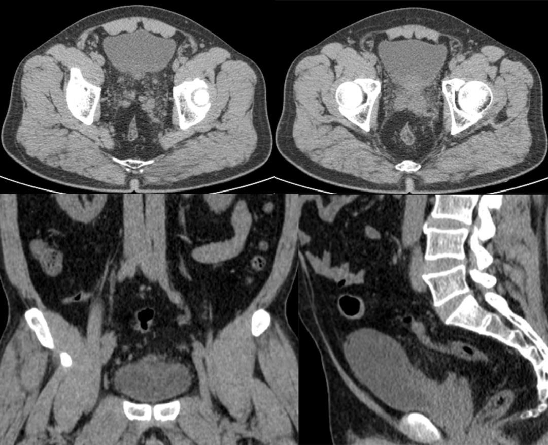 【病例】腺性膀胱炎2例CT影像表现-2