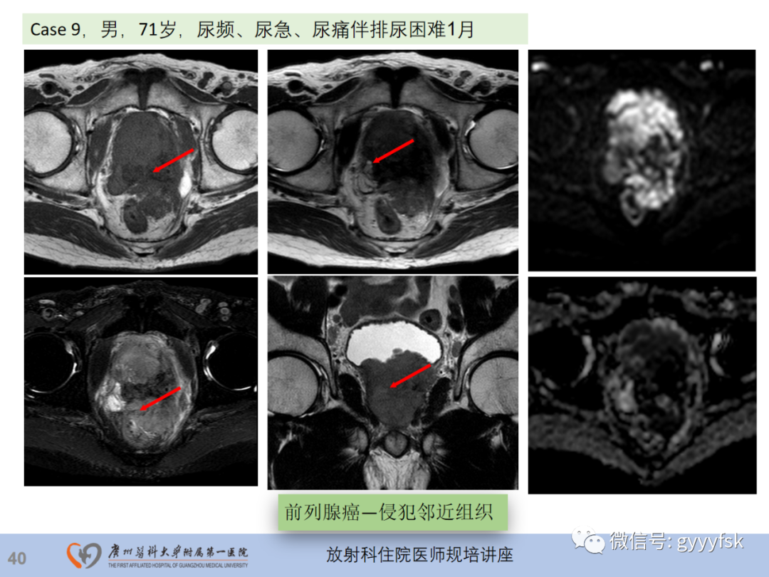 【PPT】前列腺癌的MR扫描规范及精准诊断-41