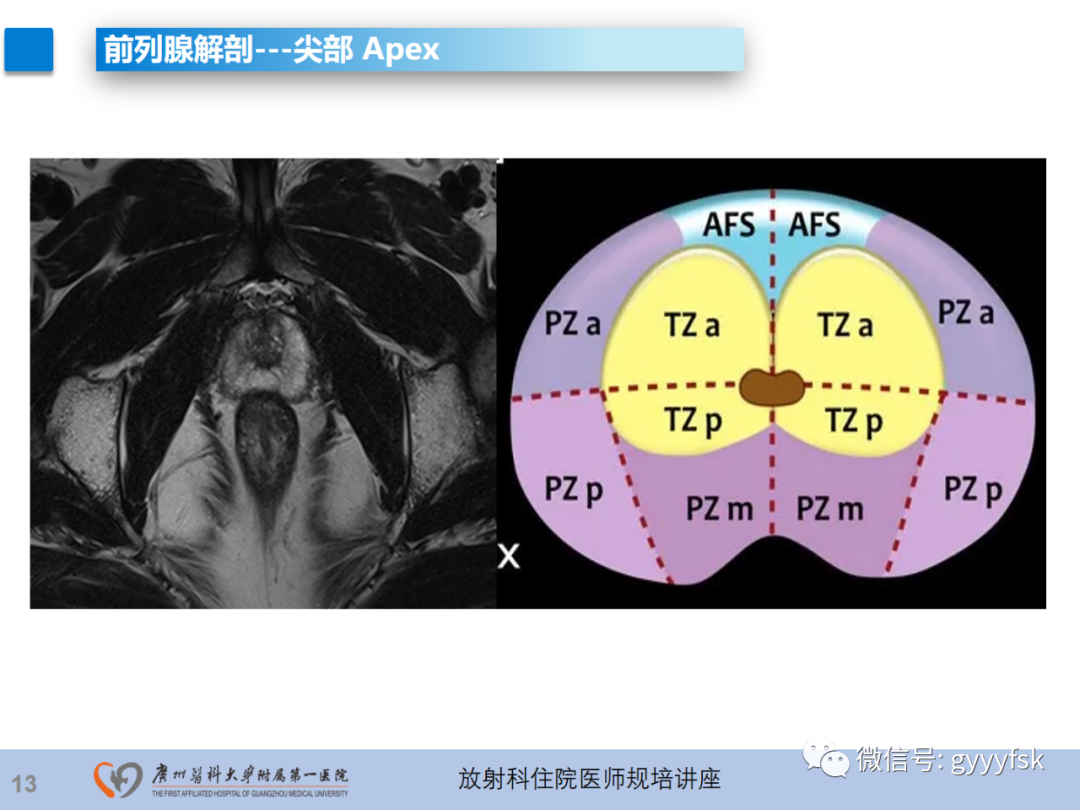 【PPT】前列腺癌的MR扫描规范及精准诊断-14