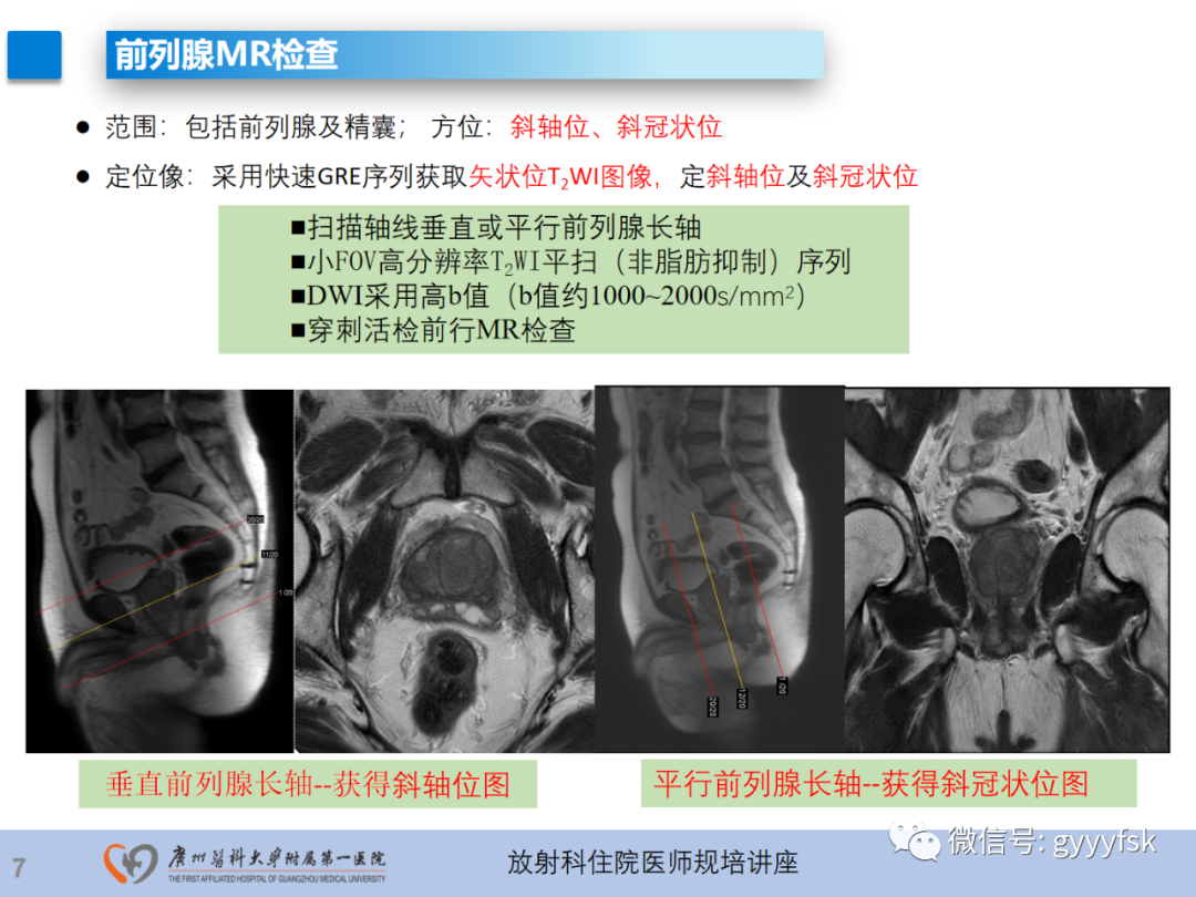 【PPT】前列腺癌的MR扫描规范及精准诊断-8