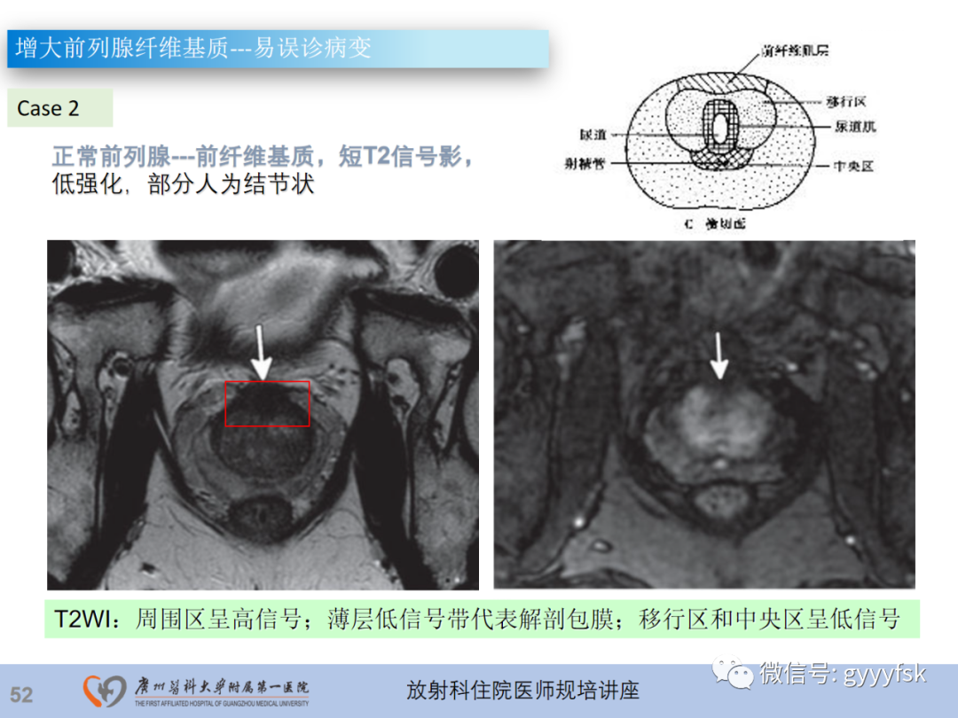 【PPT】前列腺癌的MR扫描规范及精准诊断-53