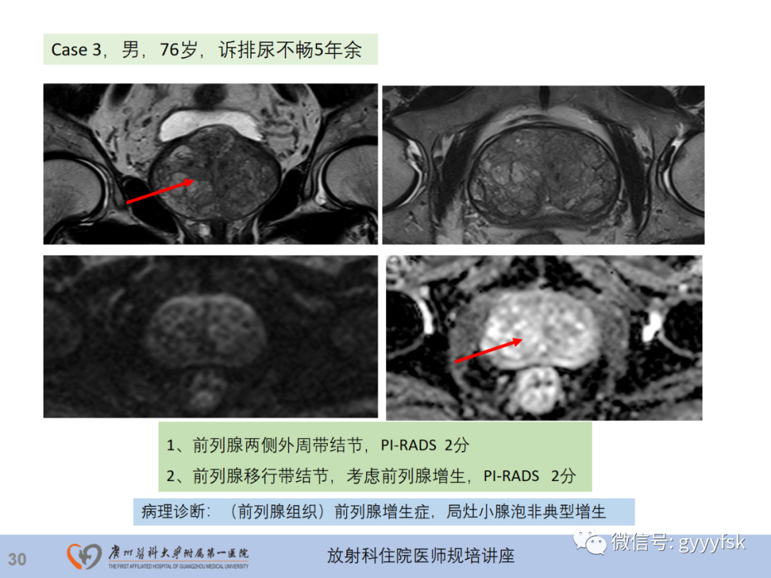 【PPT】前列腺癌的MR扫描规范及精准诊断-31