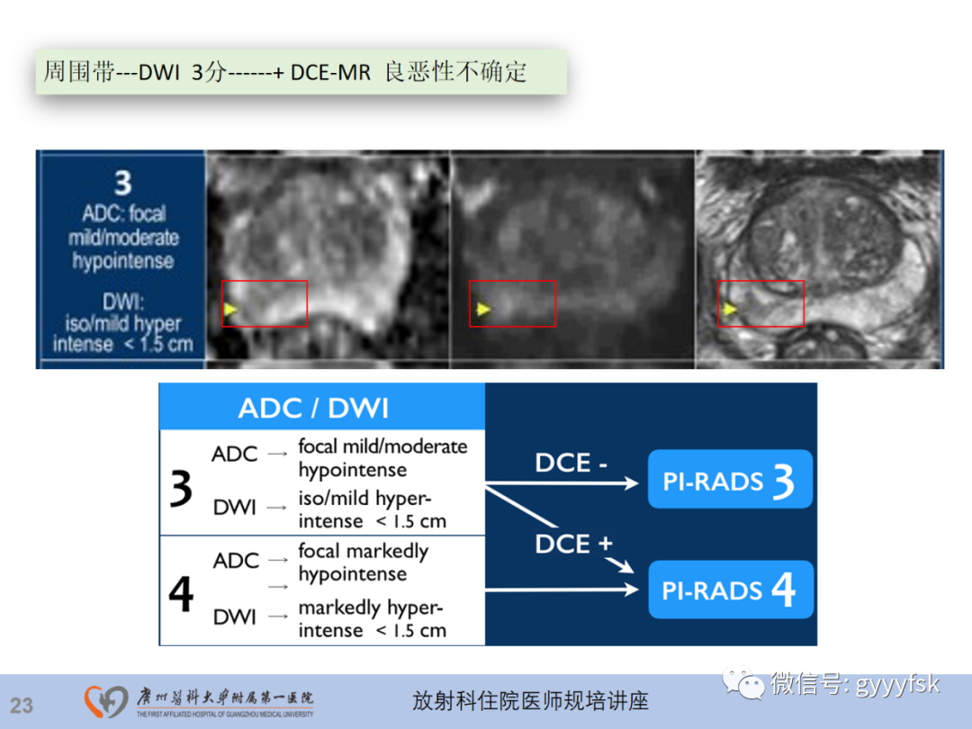【PPT】前列腺癌的MR扫描规范及精准诊断-24