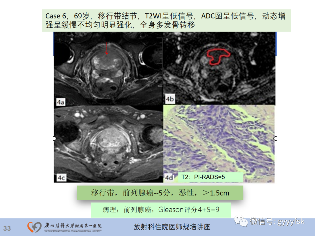 【PPT】前列腺癌的MR扫描规范及精准诊断-34