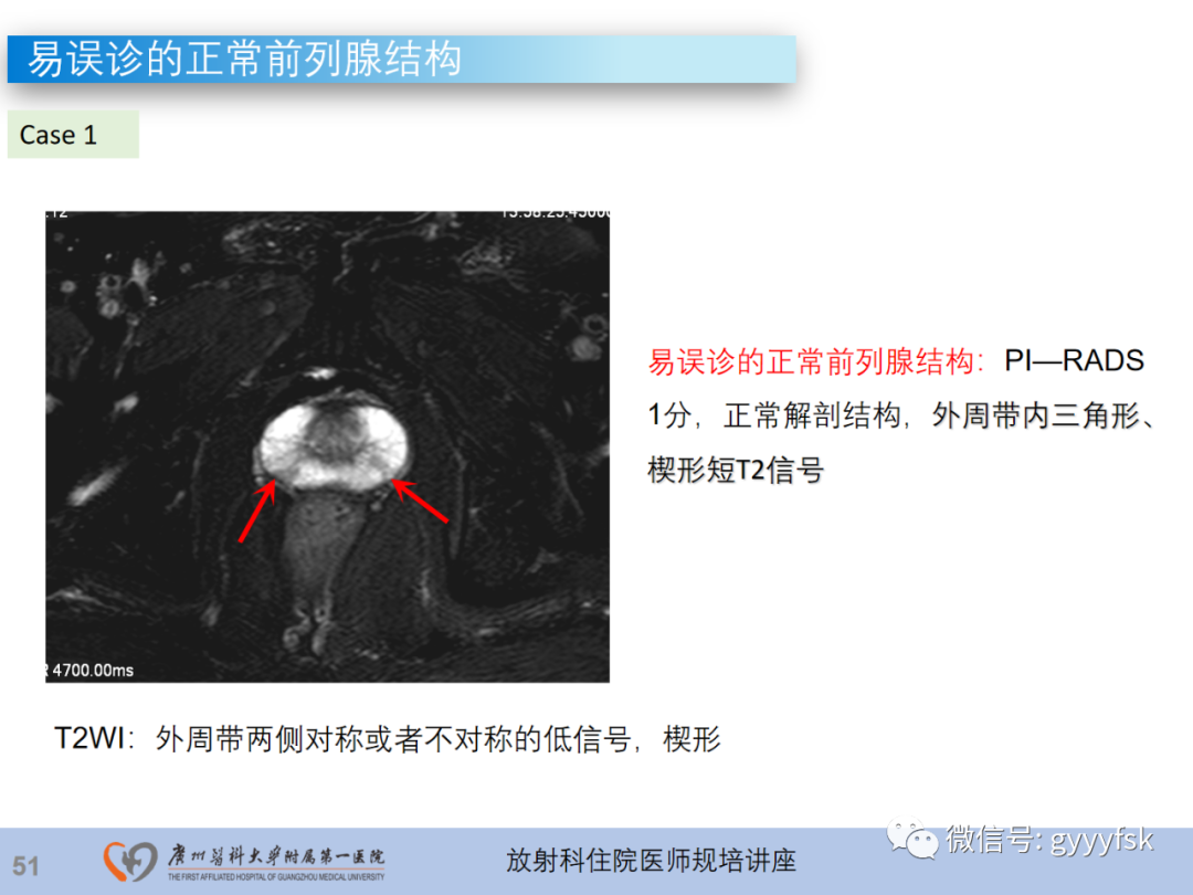【PPT】前列腺癌的MR扫描规范及精准诊断-52