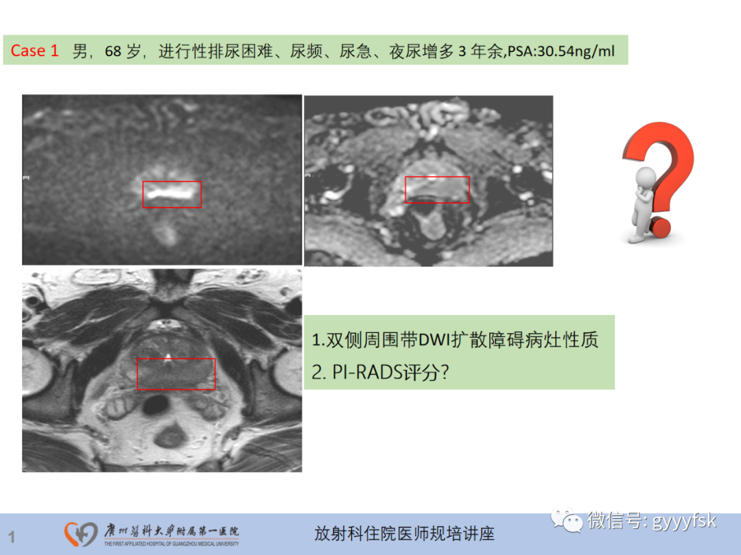 【PPT】前列腺癌的MR扫描规范及精准诊断-2