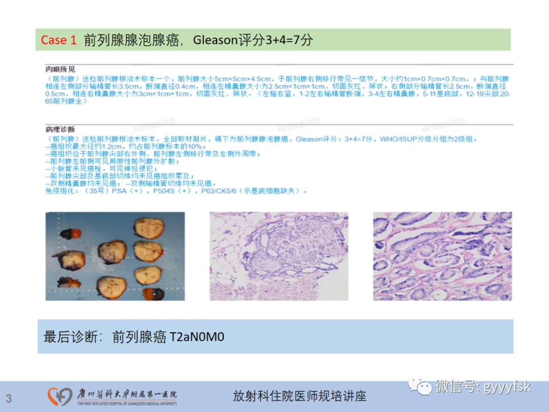 【PPT】前列腺癌的MR扫描规范及精准诊断-4