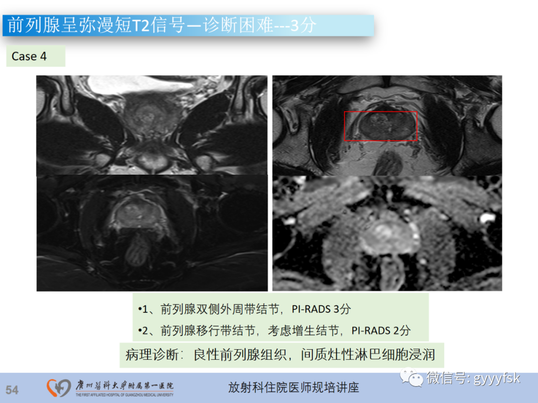 【PPT】前列腺癌的MR扫描规范及精准诊断-55