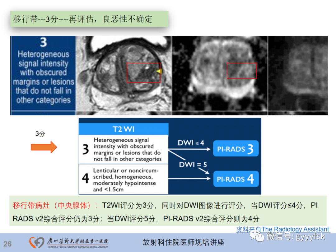 【PPT】前列腺癌的MR扫描规范及精准诊断-27