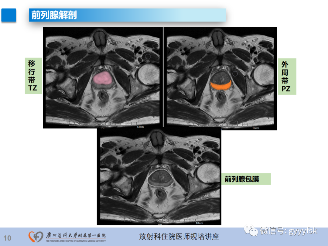 【PPT】前列腺癌的MR扫描规范及精准诊断-11