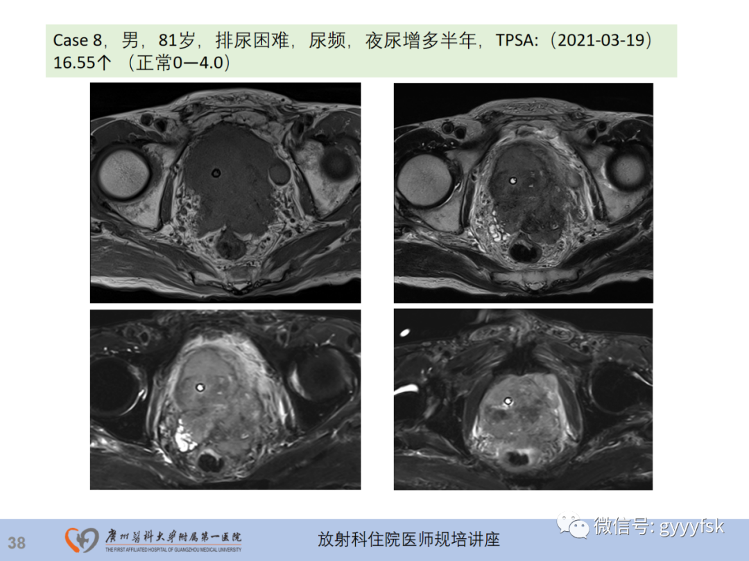 【PPT】前列腺癌的MR扫描规范及精准诊断-39