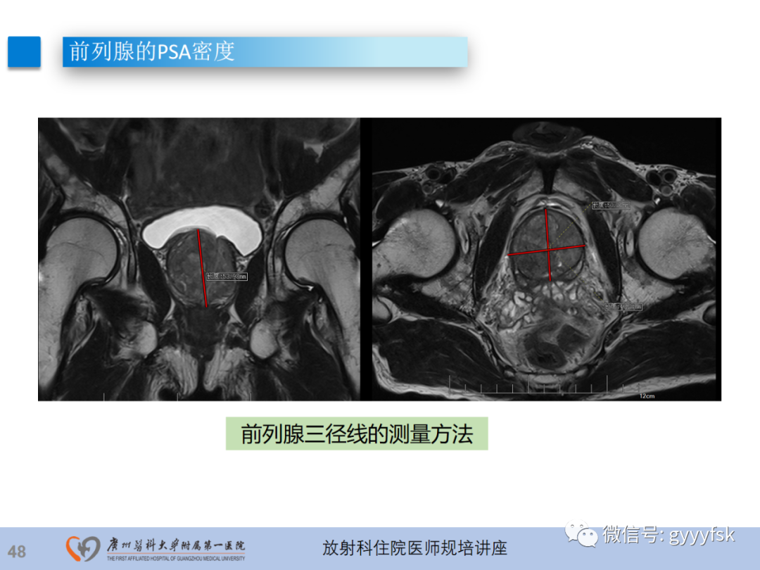 【PPT】前列腺癌的MR扫描规范及精准诊断-49