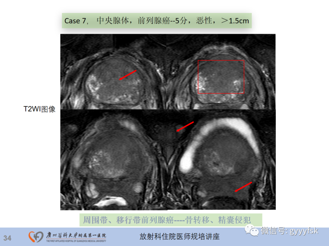 【PPT】前列腺癌的MR扫描规范及精准诊断-35