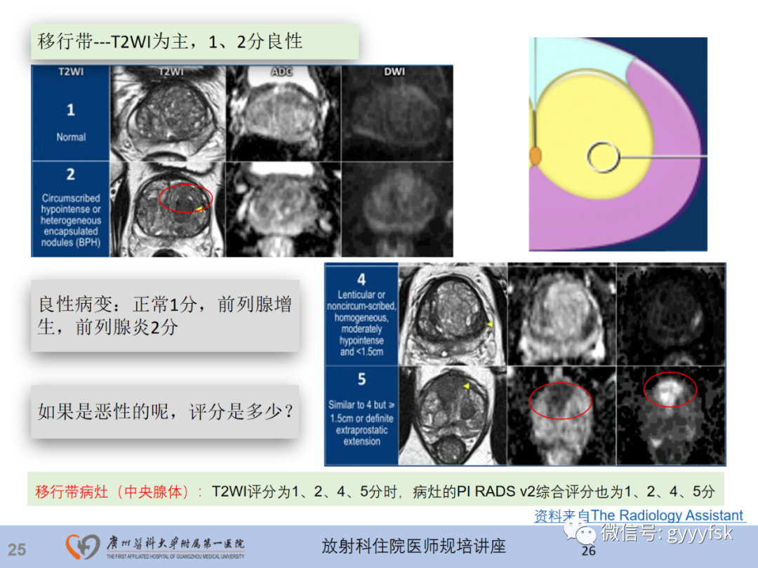 【PPT】前列腺癌的MR扫描规范及精准诊断-26