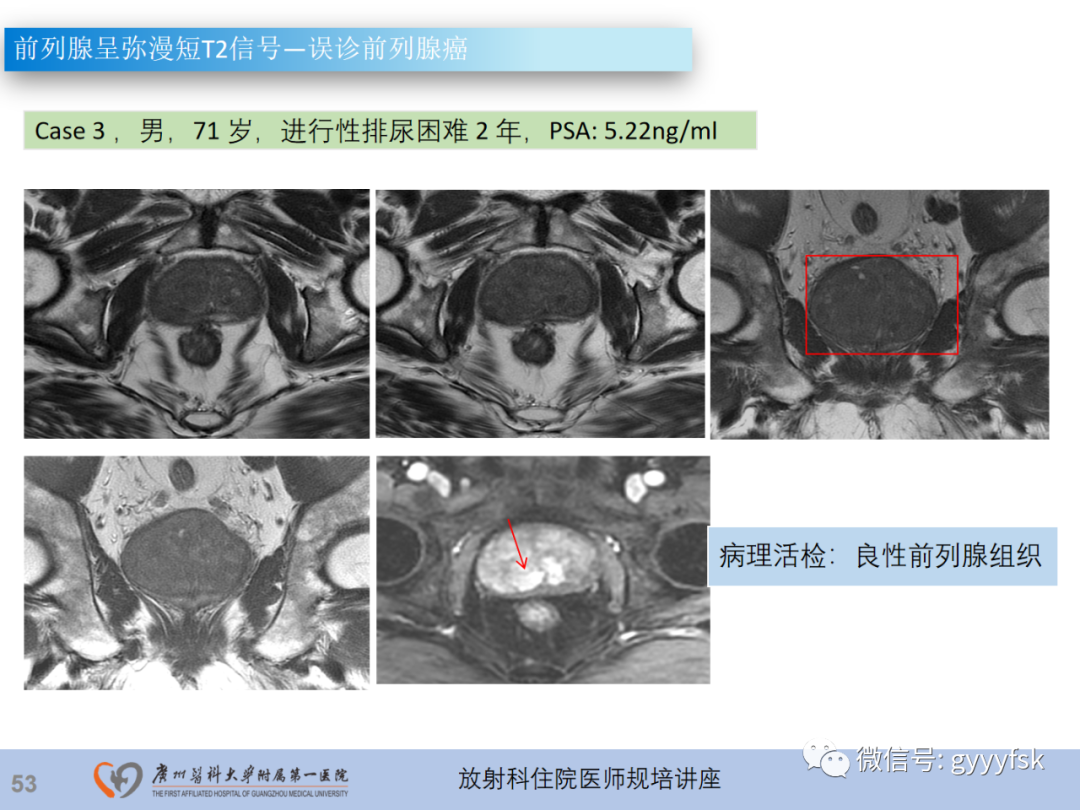 【PPT】前列腺癌的MR扫描规范及精准诊断-54