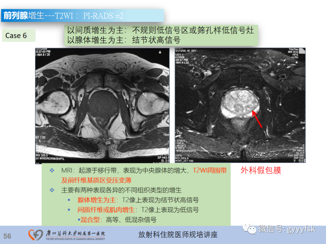 【PPT】前列腺癌的MR扫描规范及精准诊断-57