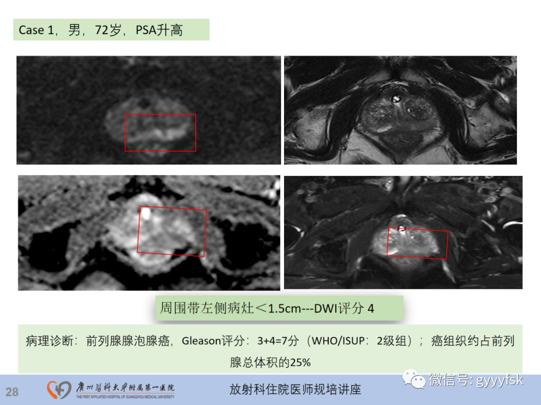 【PPT】前列腺癌的MR扫描规范及精准诊断-29