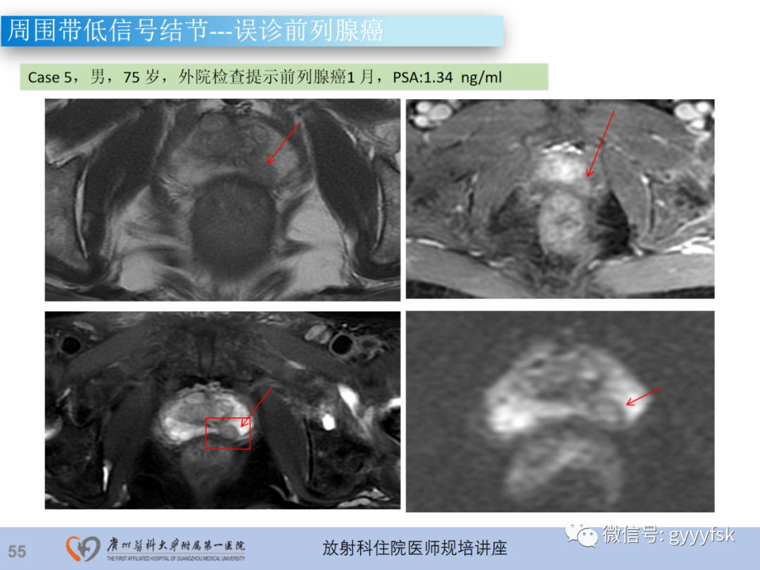 【PPT】前列腺癌的MR扫描规范及精准诊断-56
