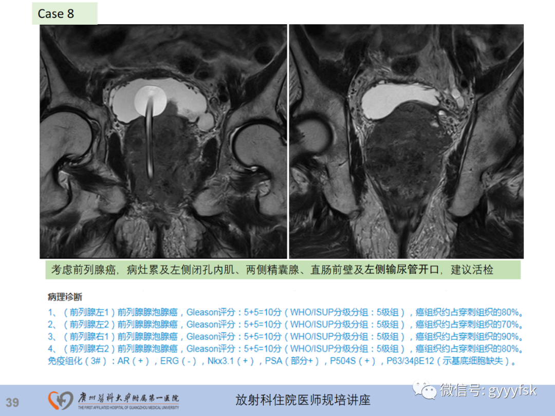 【PPT】前列腺癌的MR扫描规范及精准诊断-40