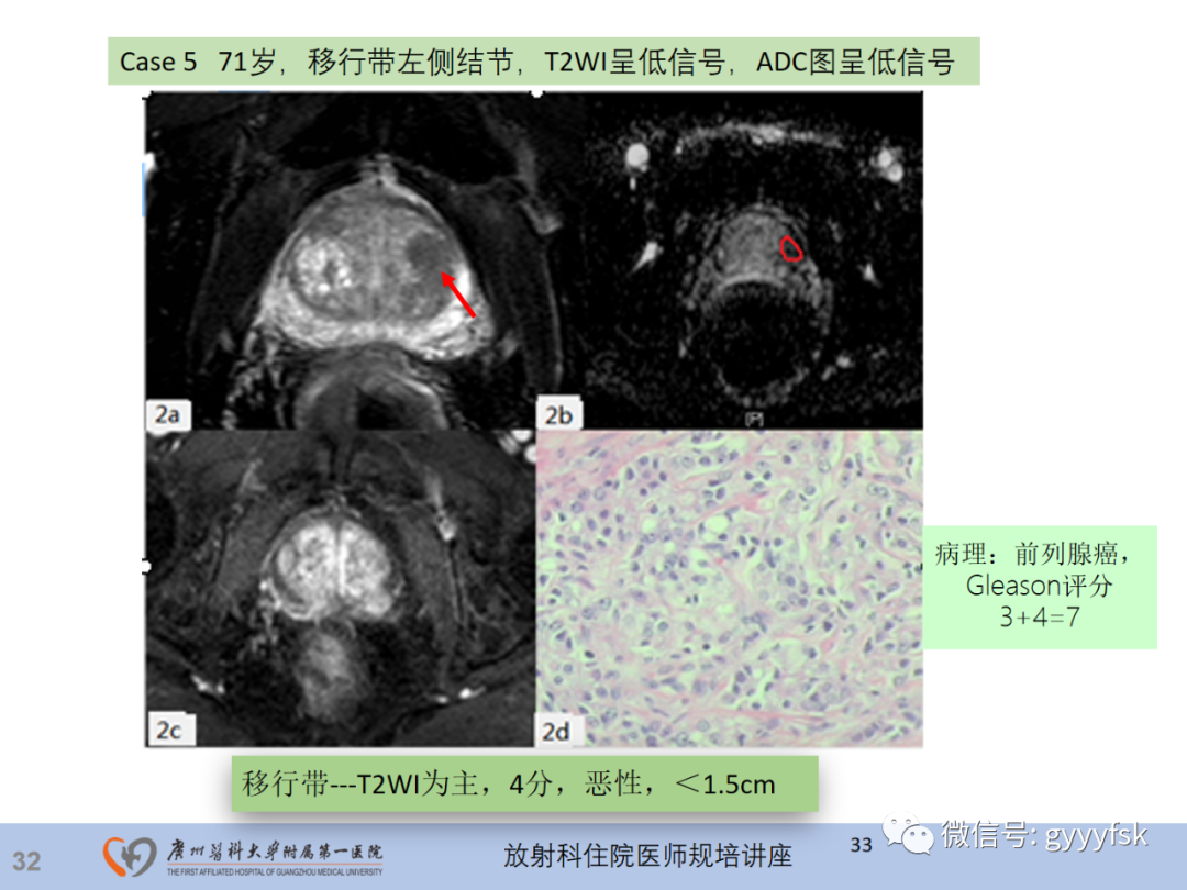 【PPT】前列腺癌的MR扫描规范及精准诊断-33