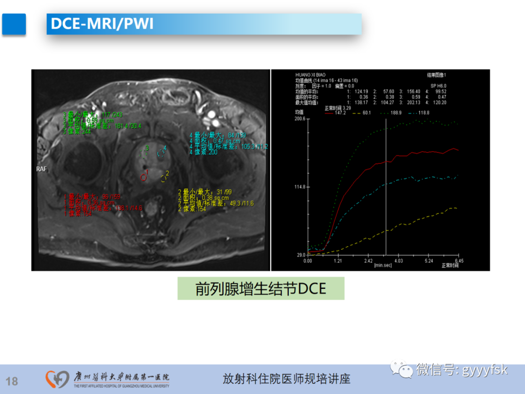 【PPT】前列腺癌的MR扫描规范及精准诊断-19