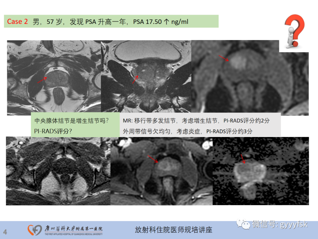 【PPT】前列腺癌的MR扫描规范及精准诊断-5