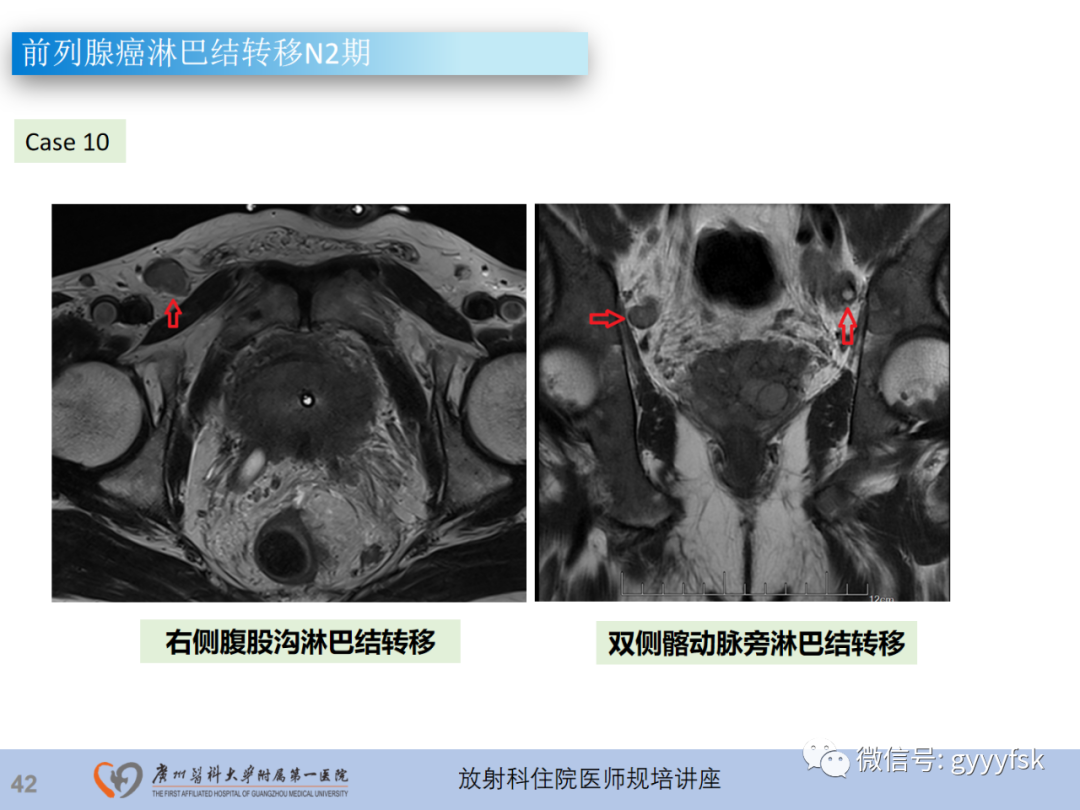 【PPT】前列腺癌的MR扫描规范及精准诊断-43