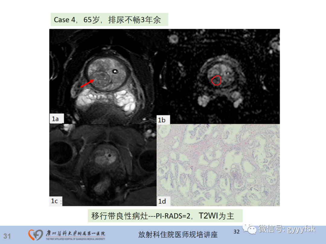 【PPT】前列腺癌的MR扫描规范及精准诊断-32