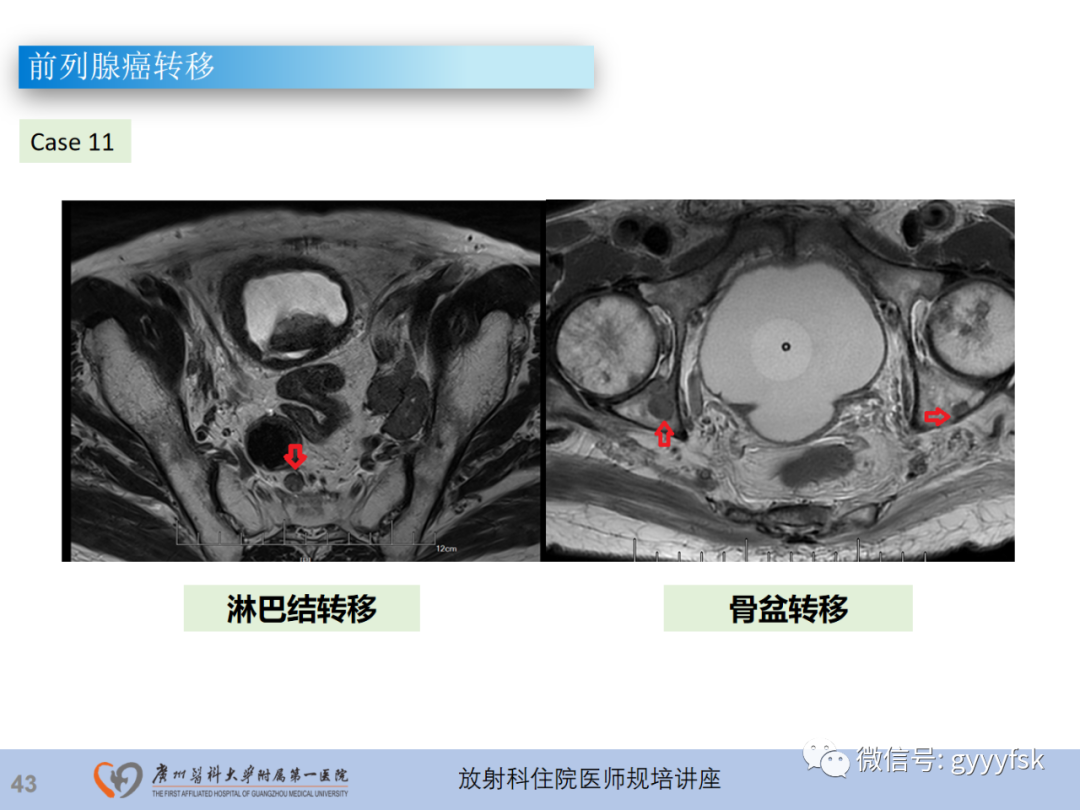【PPT】前列腺癌的MR扫描规范及精准诊断-44