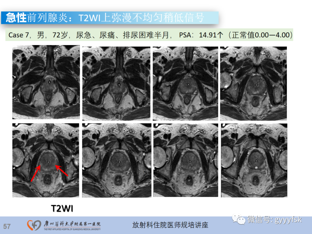【PPT】前列腺癌的MR扫描规范及精准诊断-58