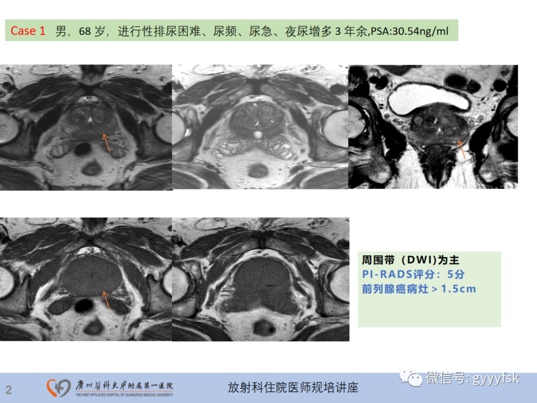 【PPT】前列腺癌的MR扫描规范及精准诊断-3