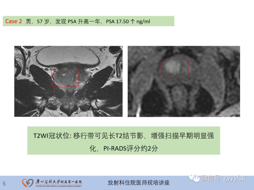 【PPT】前列腺癌的MR扫描规范及精准诊断-6