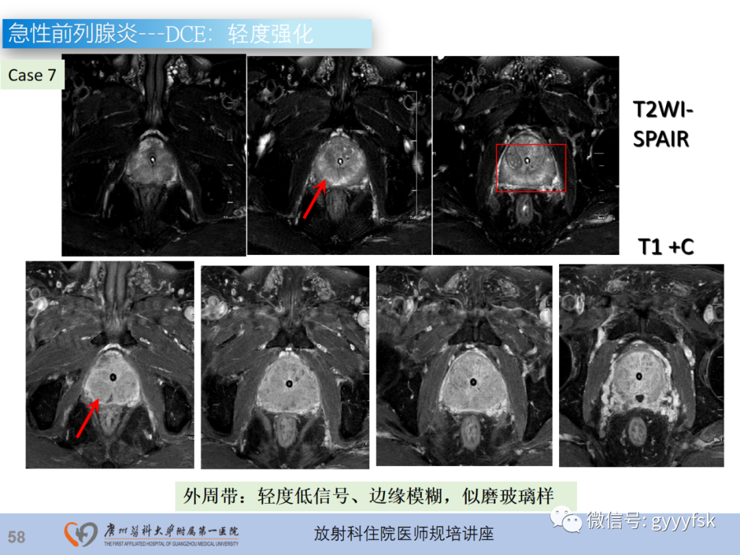 【PPT】前列腺癌的MR扫描规范及精准诊断-59
