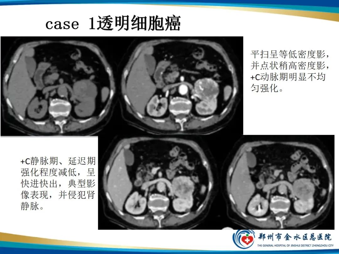 【PPT】肾细胞癌-5