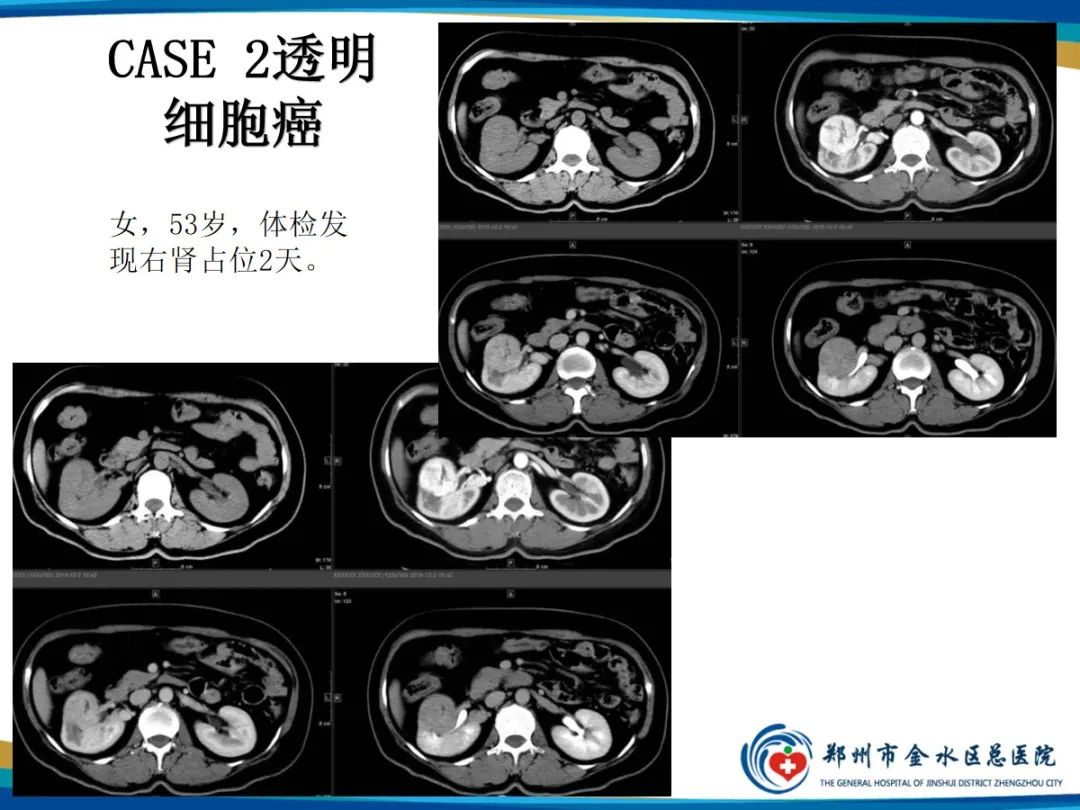 【PPT】肾细胞癌-6