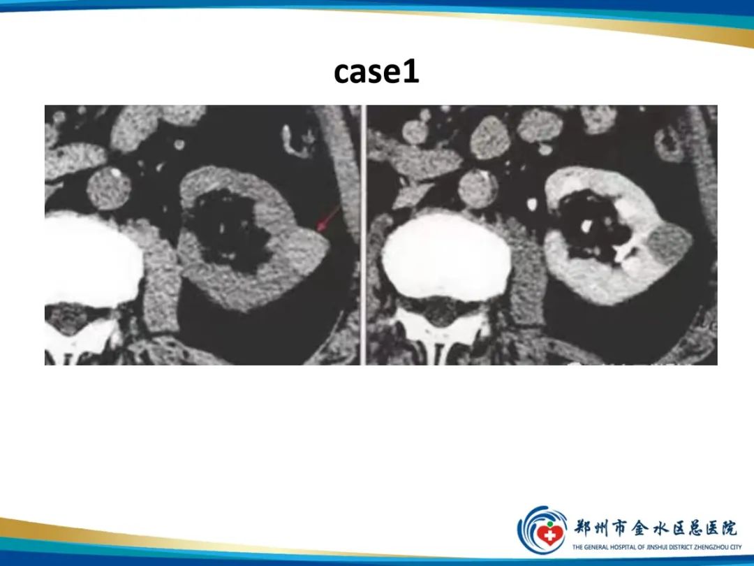 【PPT】肾细胞癌-19
